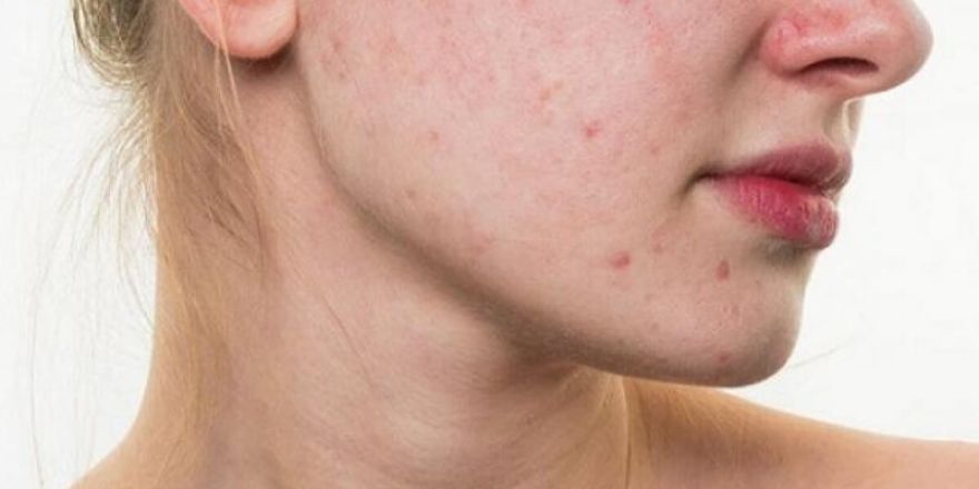Chăm sóc sức khoẻ: Da mặt bị dị ứng có nên xông hơi không Da-di-ung-nhe-co-the-ap-dung-phuong-phap-xong-hoi